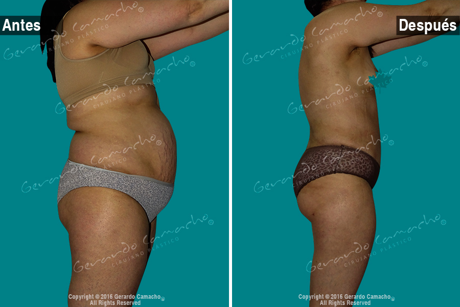 Contorno del abdomen definido en Bogotá con abdominoplastia